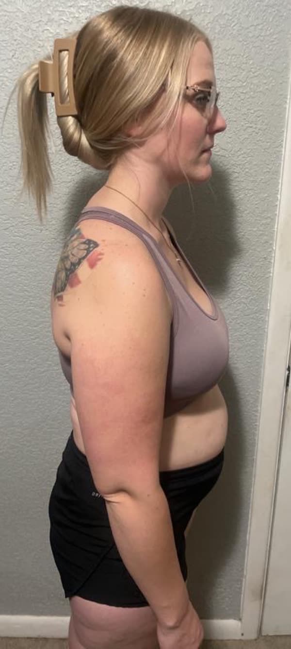 Anna before, side view